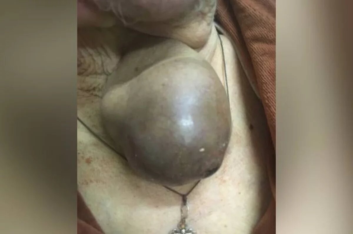    В Твери 90-летней пациентке удалили гигантскую опухоль