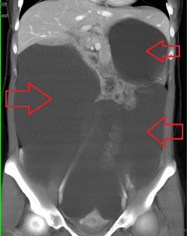 Красные стрелки указывают на жидкость, занимающую на представленной компьютерной томографии большую часть брюшной полости. Печень и селезенка отдавлены жидкостью кверху, в этой ситуации также происходит компрессия нижних долей легких, может возникнуть дыхательная недостаточность.
