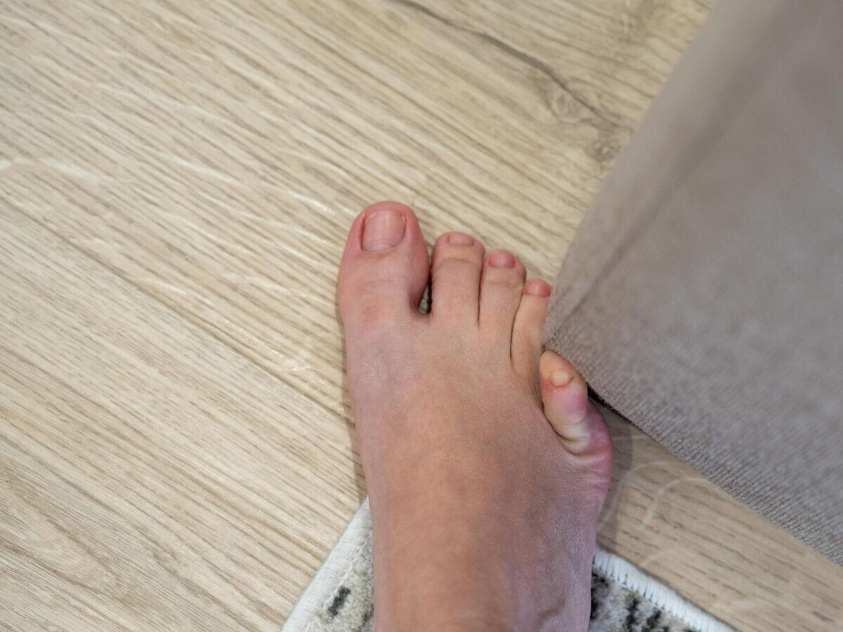    Травма мизинца © iStock.com / Mariakray