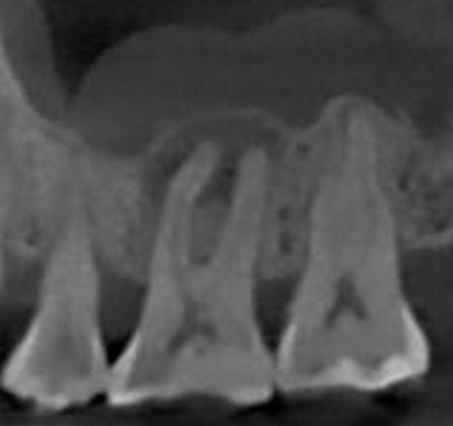 Зуб до лечения