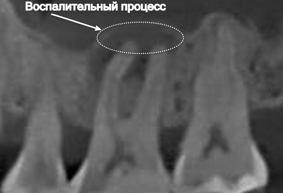 Радикулярная киста зуба 1.6
