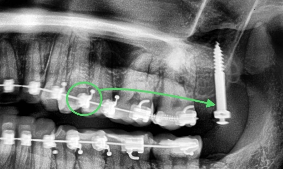 Схематичное изображение на рентгенограмме тяги от верхнего первого премоляра к минивинту.