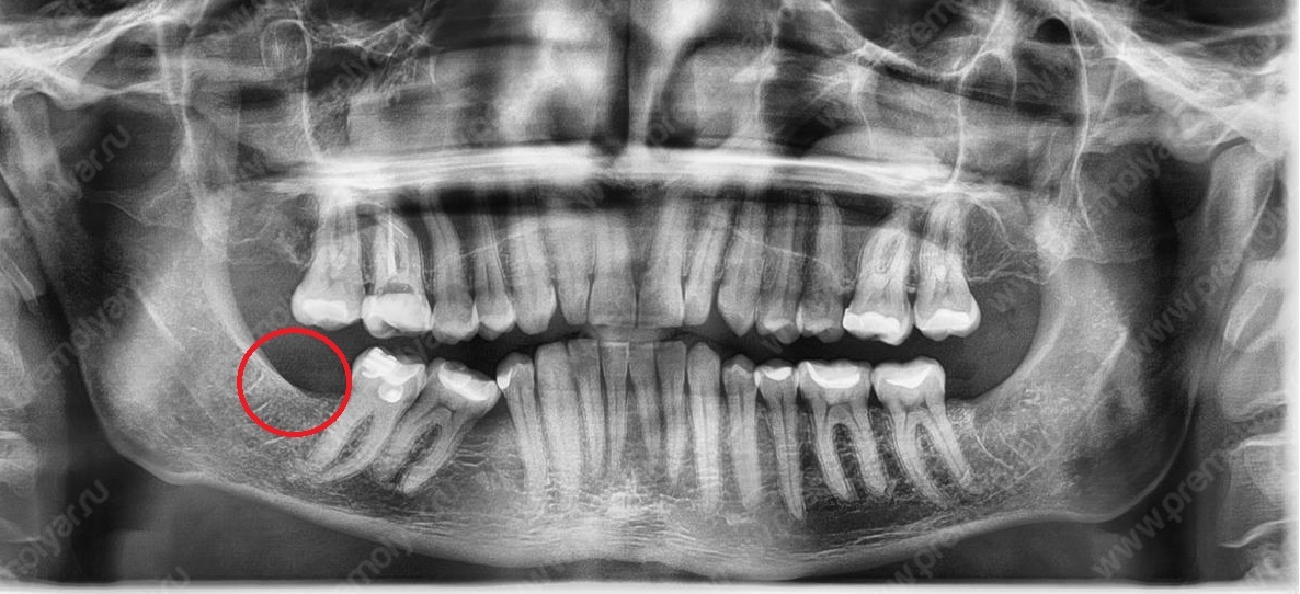 На рентгенограмме «До» мы видим отсутствие места для имплантации отсутствующего премоляра (зуба 4.5).