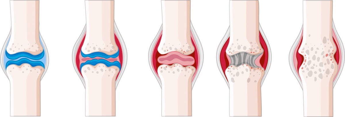степени остеоарита.