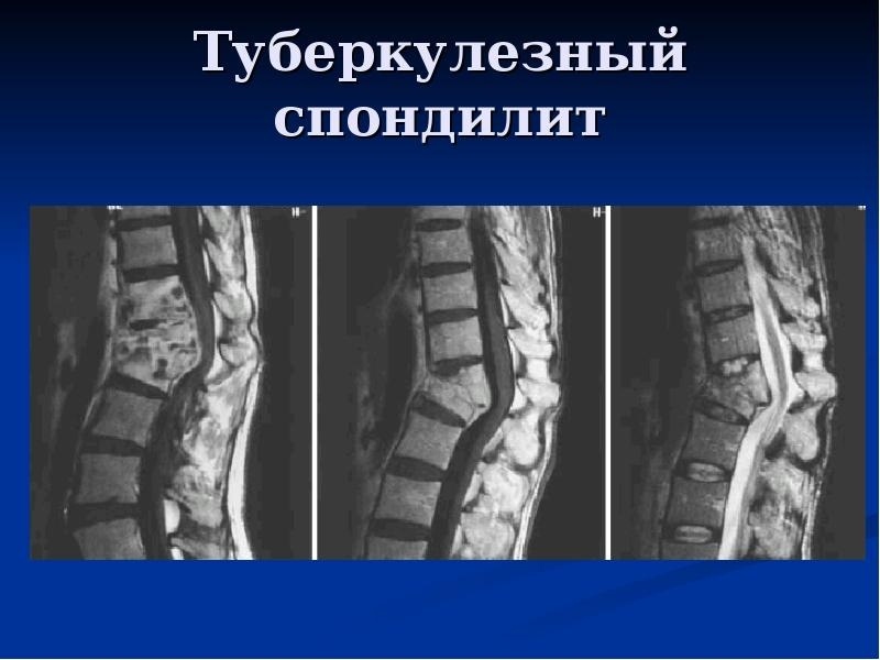 Болезнь Потта — туберкулёз позвоночника