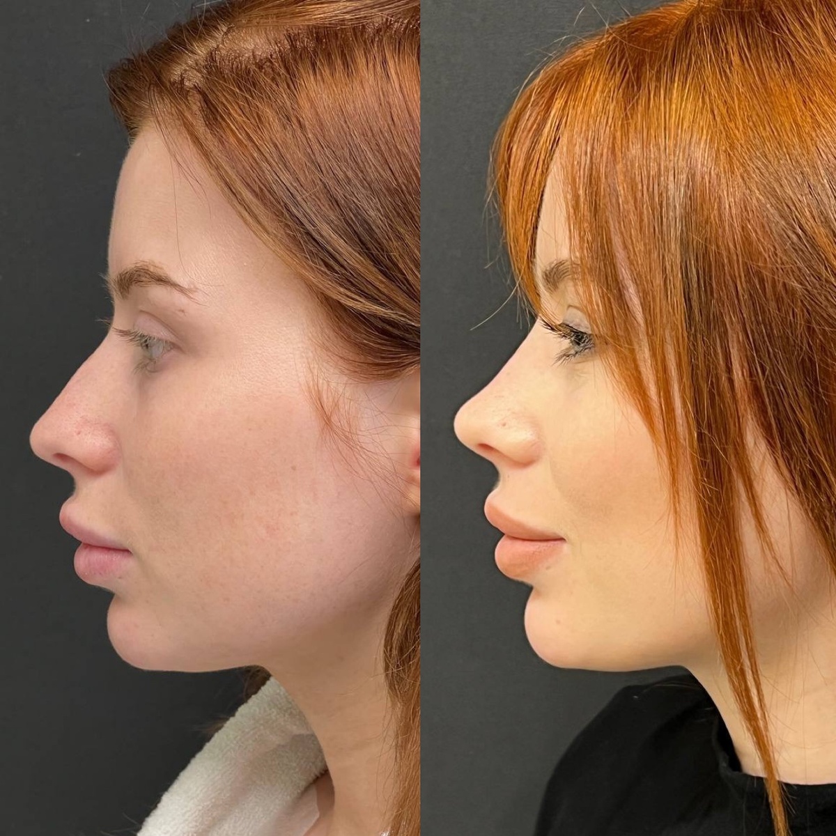 Месяц после ринопластики