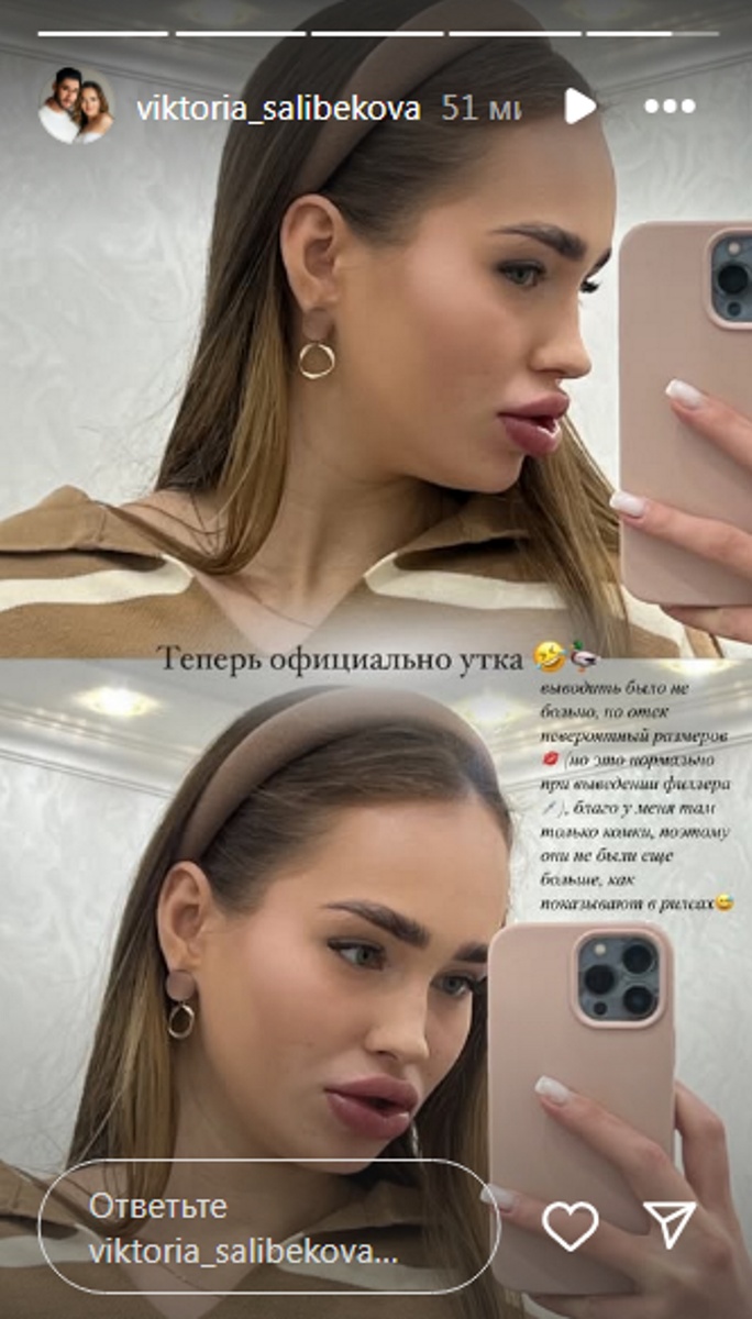 Виктория Лысковец уменьшила губы. Фото: соцсети