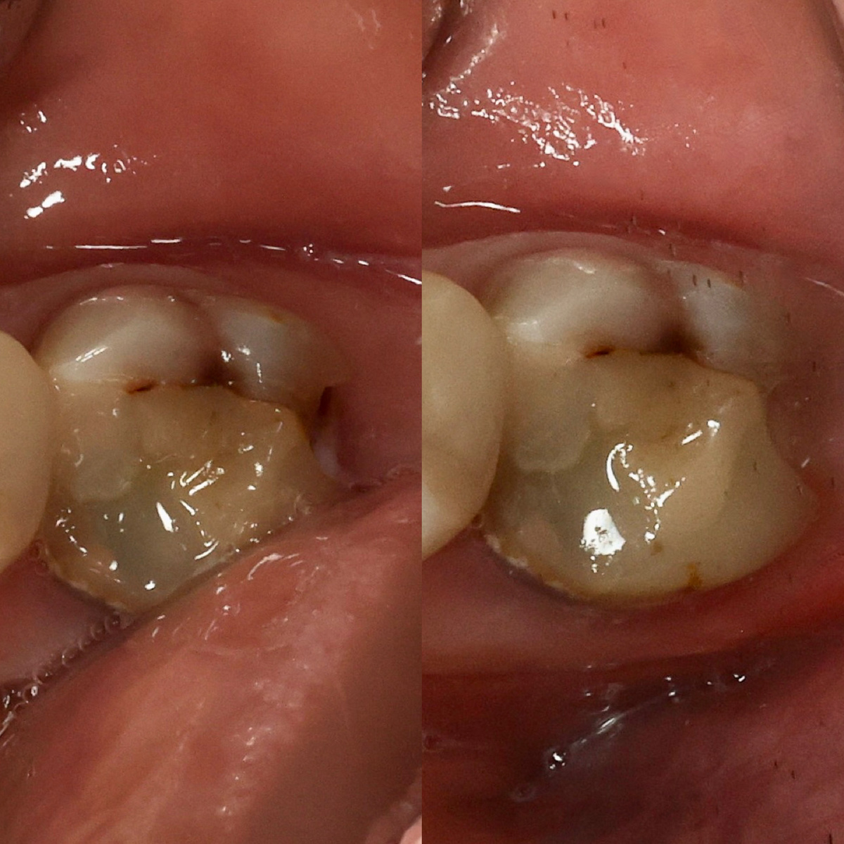 Снимок я слепила из того, что было - зуб 3.7 до лечения