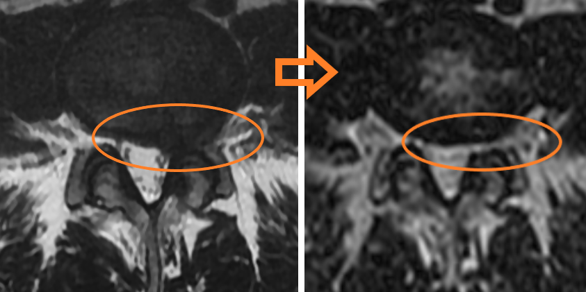 Пример резорбции грыжи диска L4-L5