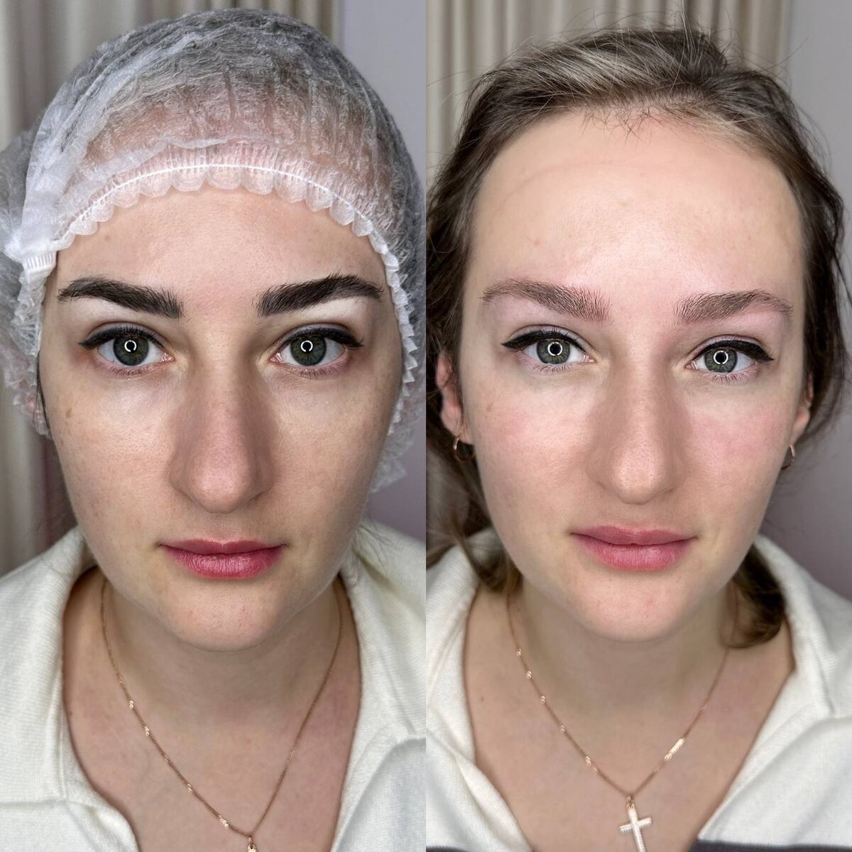 один визит удаления лазером