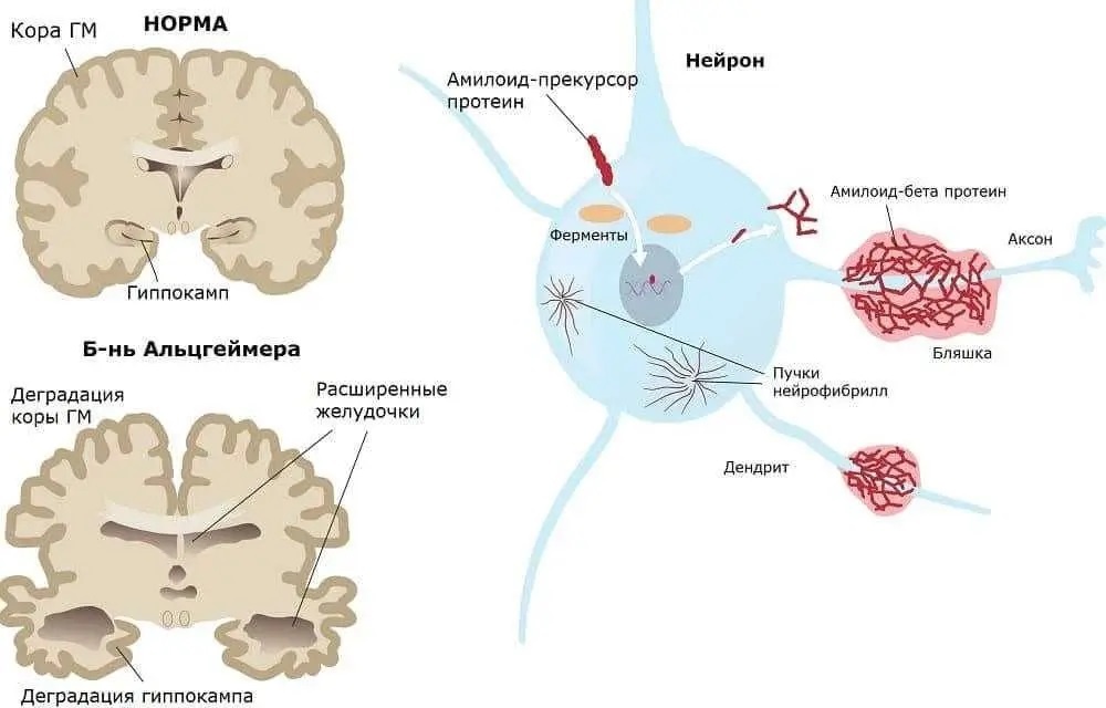 Болезнь Альцгеймера (Источник изображения: https://newneuro.ru/simptomy-alczgejmera-u-molodyh/)