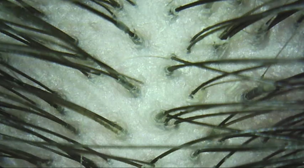 Так выглядит не до конца очищенная кожа. Устья забиты и волосу сложнее расти и получать необходимый кислород извне для фолликулы.