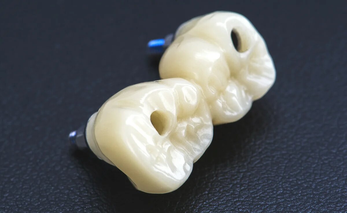 Циркониевые коронки жевательных зубов на имплантатах