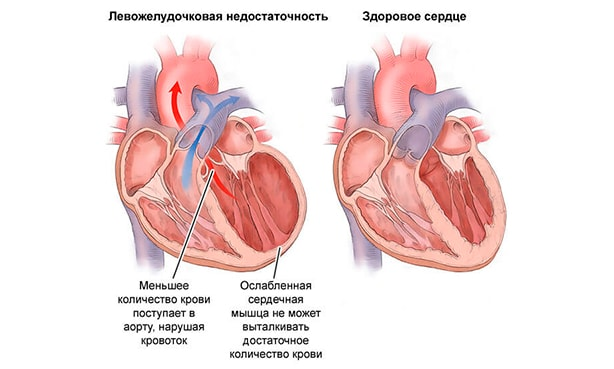 От какого варианта сердечной недостаточности можно избавиться полностью?