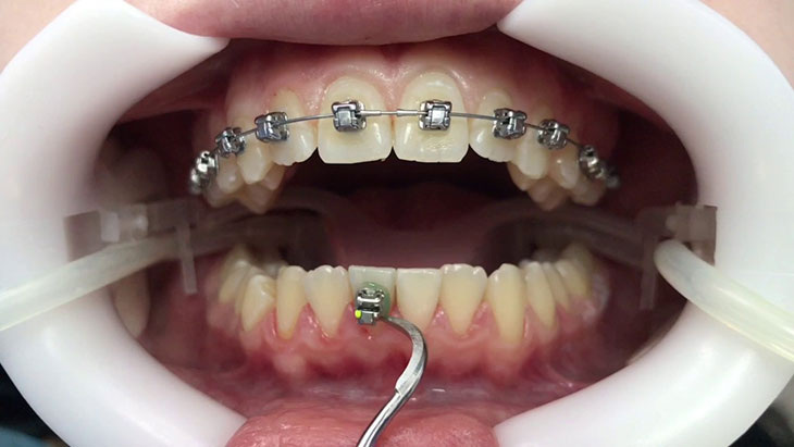 Фиксация брекетов на зубы.