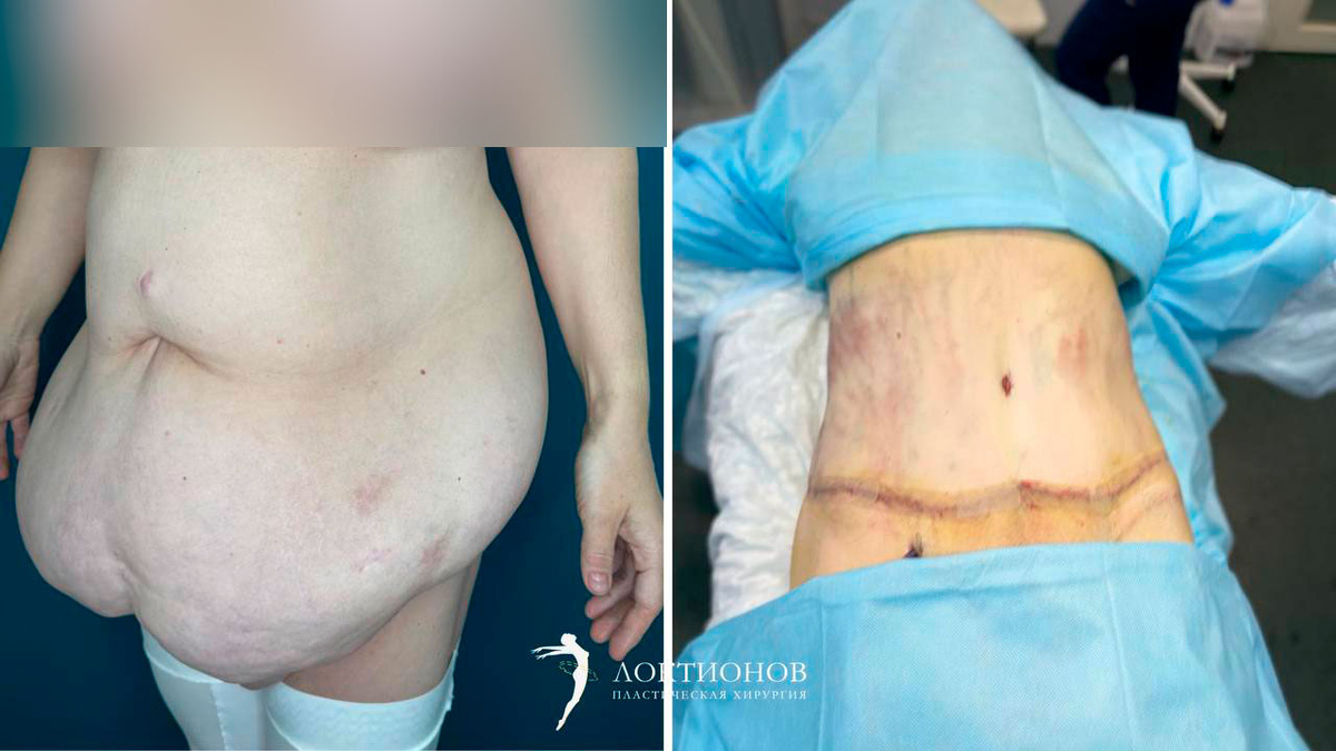 Пластический хирург А.Г. Локтионов: фото до/после абдоминопластики
