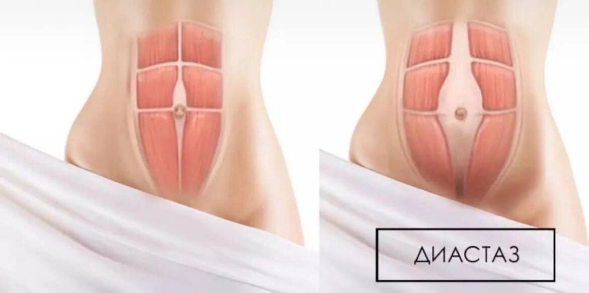 Диастаз. Только ушивать??? Доктор Сабуров. Остеопат. Онлайн-курсы, консультации. Все о здоровье мам и малышей