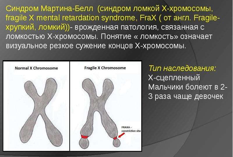 Коротко про Синдром Мартина-Белла или «зачем нужен генетик при РАС».