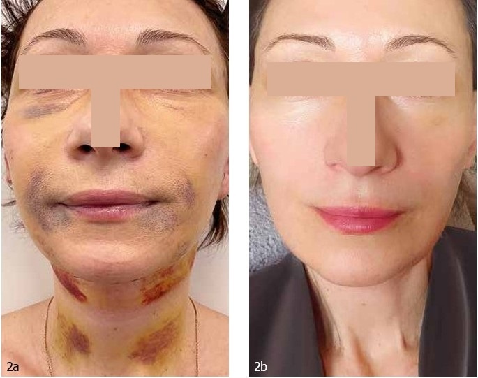 Пациент — женщина, 52 года. A — до процедур, b — сразу после