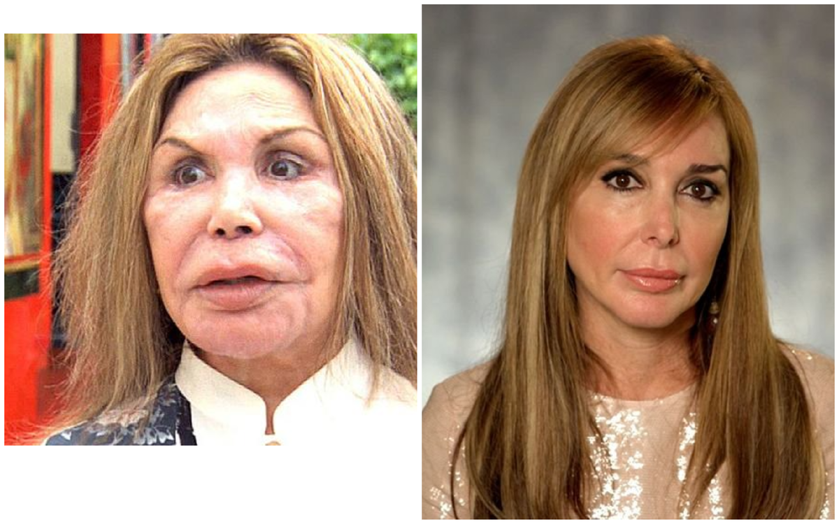 Эльза Паттон до и после пластики