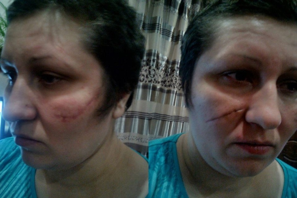 У сибирячки после нападения остались серьезные шрамы. Фото: предоставлено героиней публикации.