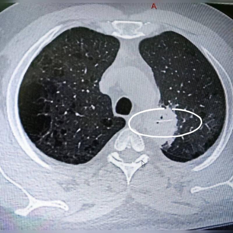    В Сургуте мужчине удалили кусок легкого из-за проглоченной рыбной кости
