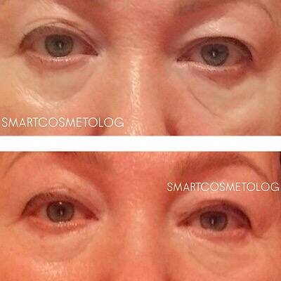 Результат использования Peptide Eye Patches: 1 фото - до применения, 2 фото - после 3-х сеансов