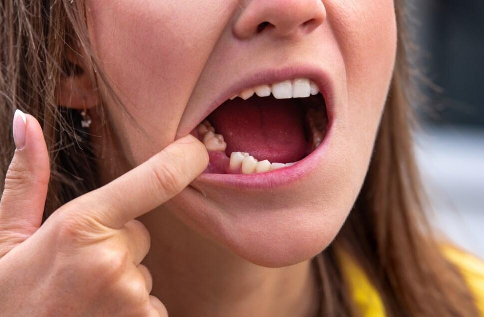 Отсутствие зуба на нижней челюсти