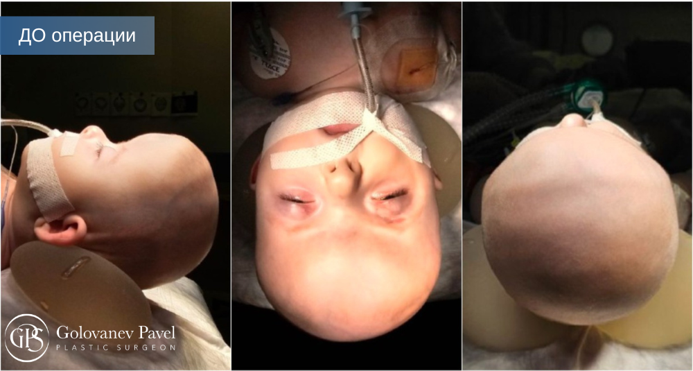 ДО операции