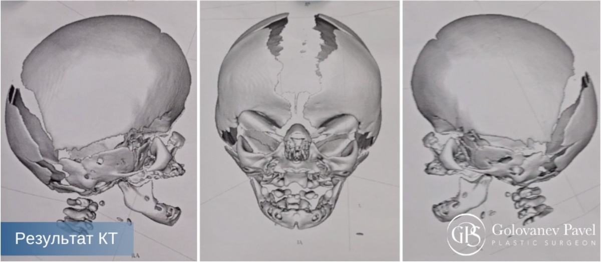 Результат компьютерной томограммы ДО операции
