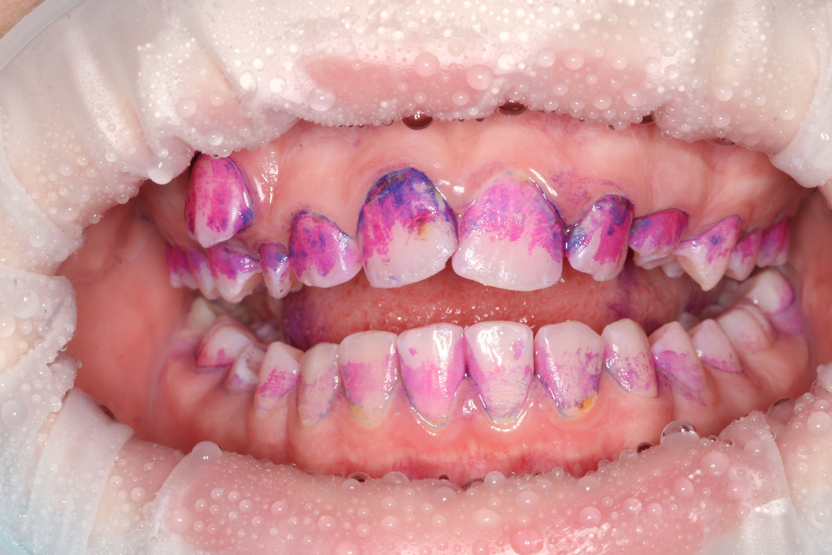 Окрашивание налета. Фиолетовые участки – место скопления остатков пищи.