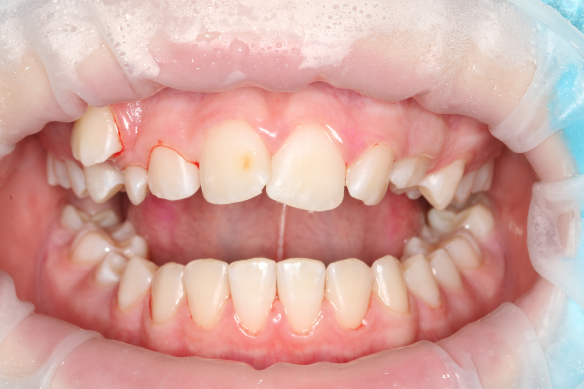 Ситуация сразу после чистки. Можно начинать ортодонтическое лечение.