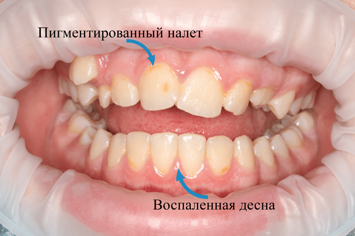 Есть окрашенный налет и воспаленная десна. При регулярной гигиене проблема уходит.