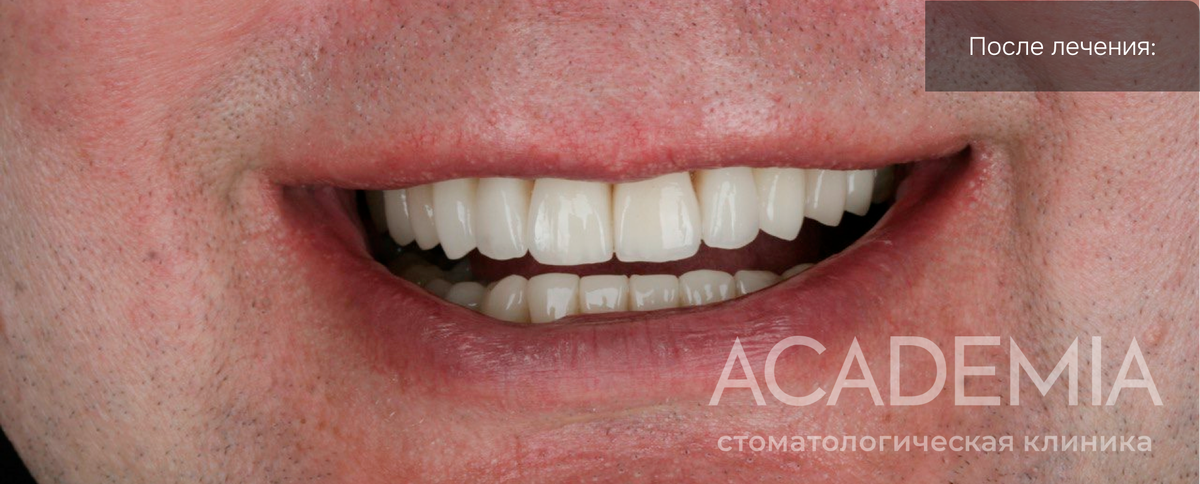 После установки винирова