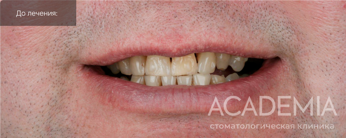 До установки виниров