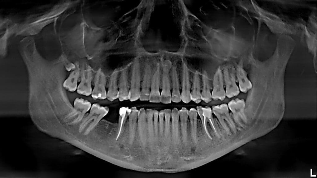    Коренные зубы, пораженные кариесом, могут провоцировать частые ангины. Источник изображения: 7gsp.by
