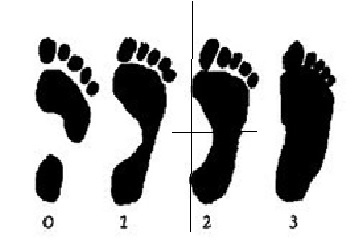 Диагностика плоскостопия по отпечатку