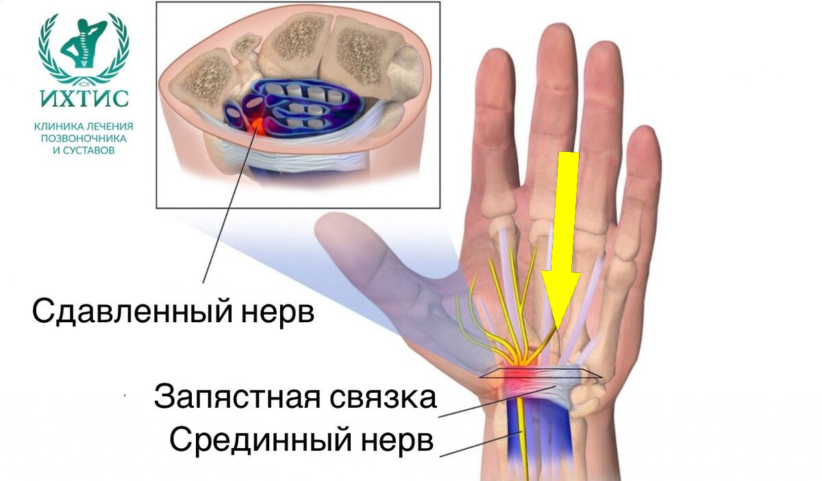    Почему к утру немеют руки: загадка ночного времени
