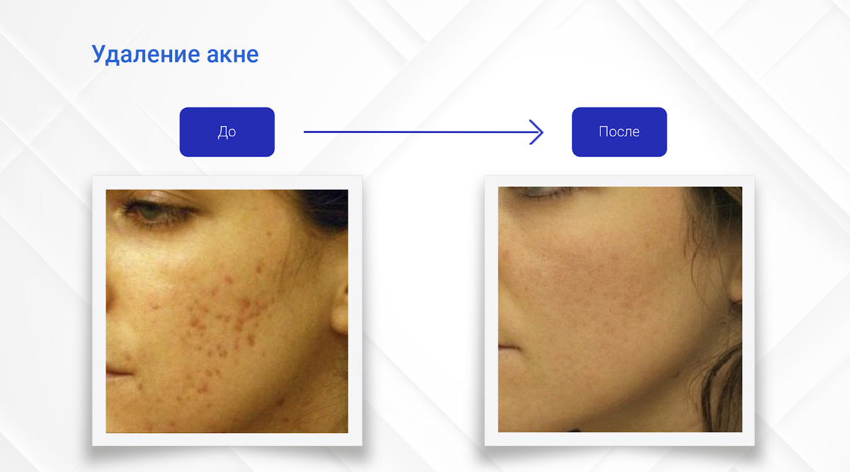 TuaRen — это косметологическая многофункциональная лазерная платформа 5 в 1