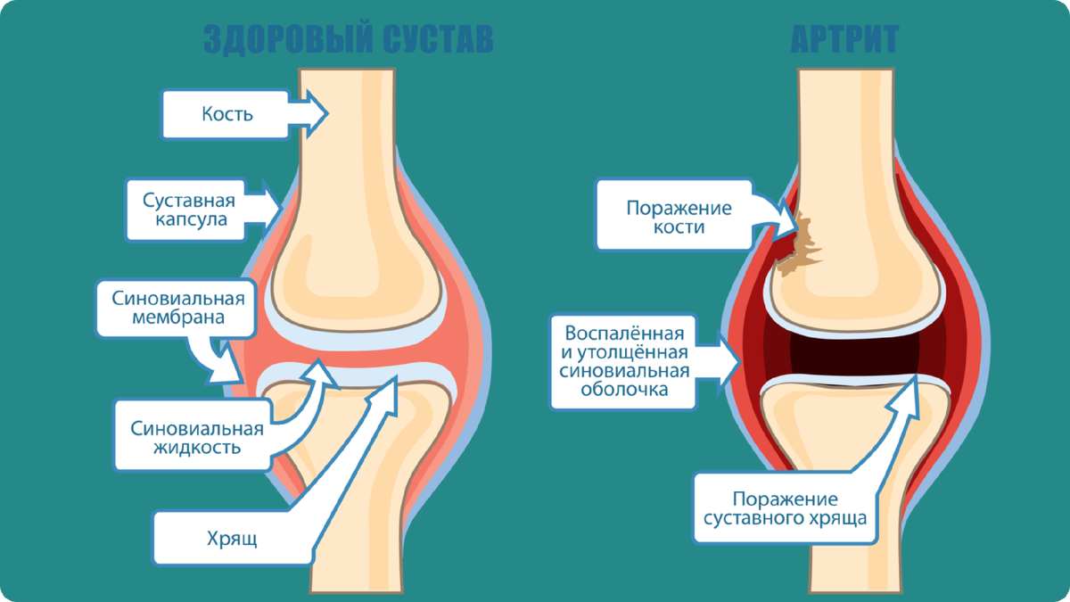 Питание при артрозе суставов: что можно есть и что нельзя