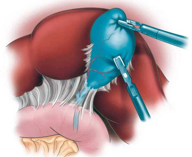 Что делать, если удален желчный пузырь
