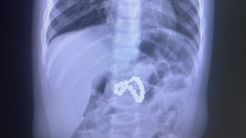    В Сургуте спасли девочку, которая проглотила магниты