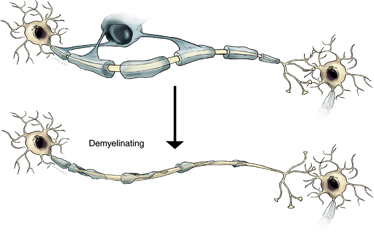 Процесс демиелинизации
