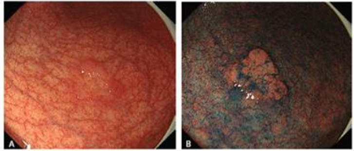 Ранний рак желудка. Слева без хромоэндоскопии, справа - изображение, полученное при хромоэндоскопии