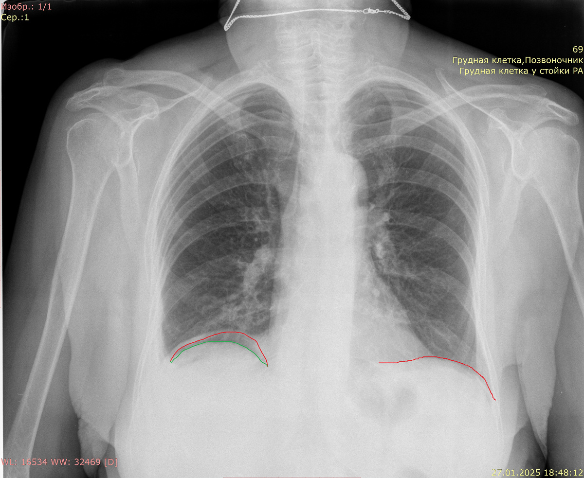 Диафрагма красная, верхний край печени зеленый. Между ними газ - симптом "серпа"