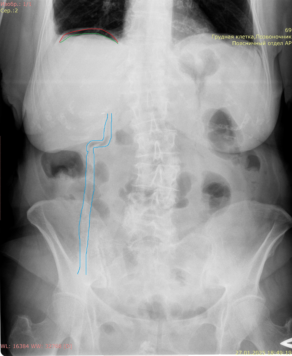 Снимок живота того же пациента. Синим выделена дренажная трубка. Вероятно, газ - послеоперационный
