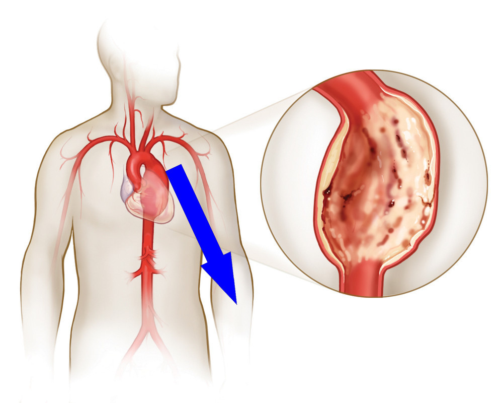    Как распознать аневризму и спасти жизнь: не упустите сигнал тревоги