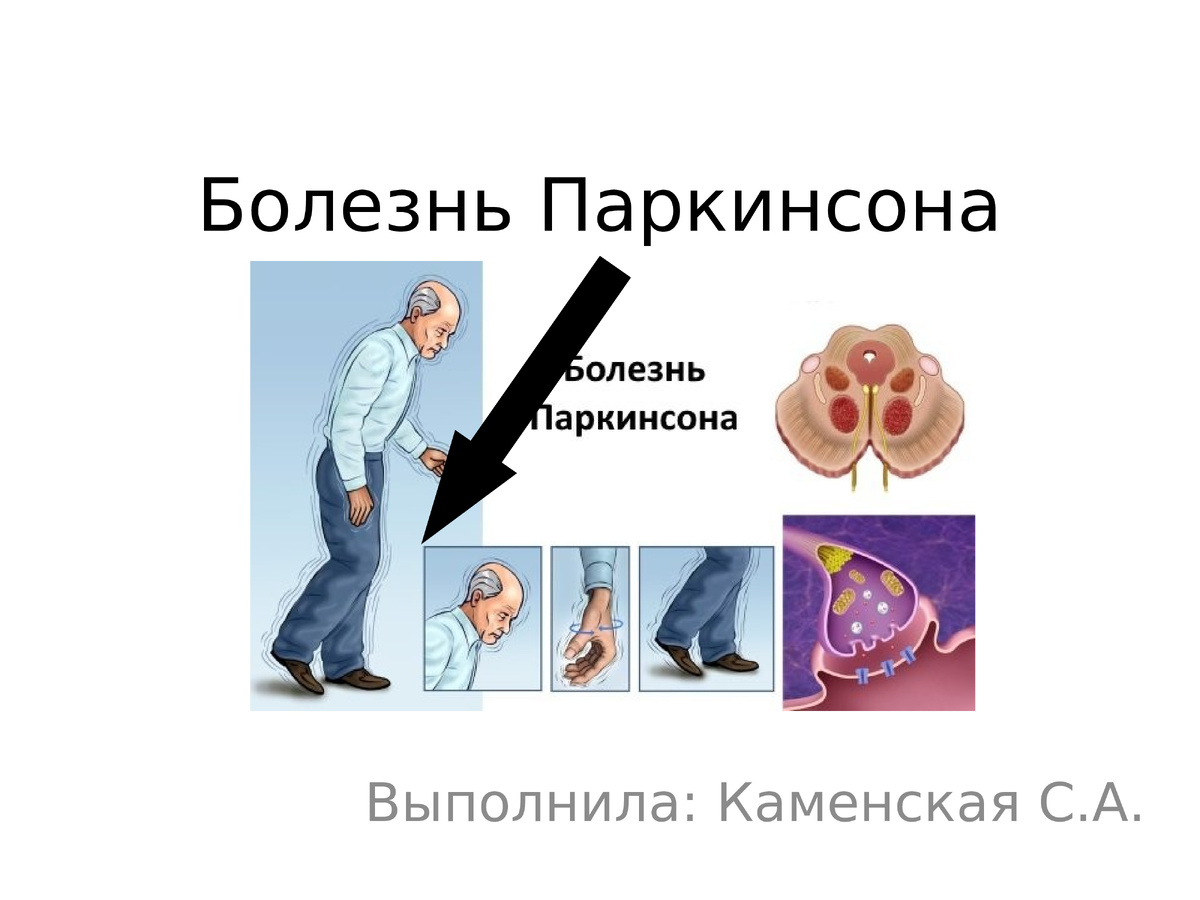    Как заметить болезнь Паркинсона, пока она еще в тени