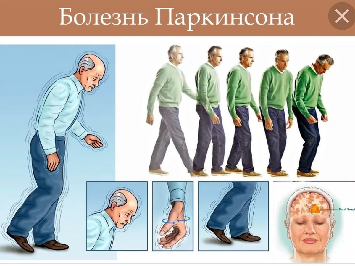    Как заметить болезнь Паркинсона, пока она еще в тени