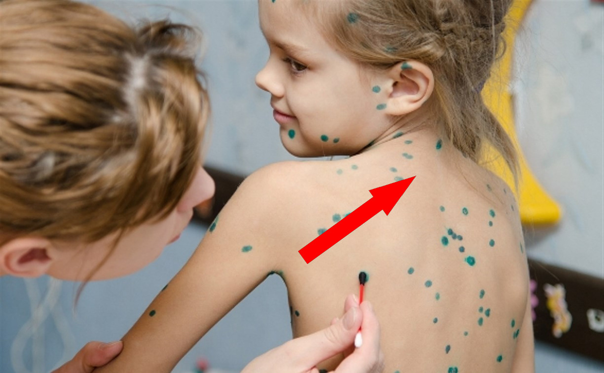    Как распознать ветрянку: знаки, которые нельзя игнорировать